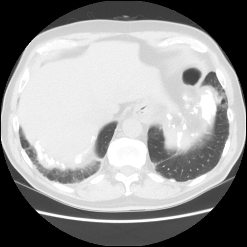 Asbestos-related pleural plaques (Radiopaedia 39069-41255 Axial lung window 62).jpg