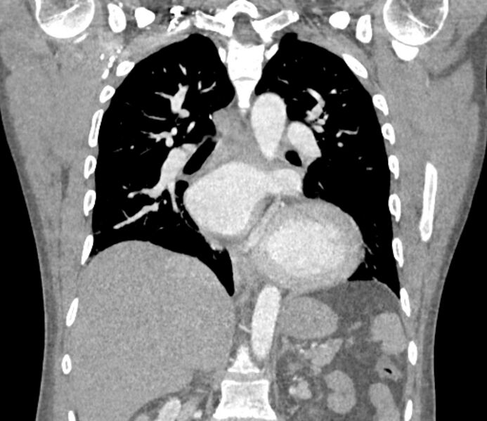 File:Ascending aortic aneurysm (Radiopaedia 86279-102297 B 40).jpg
