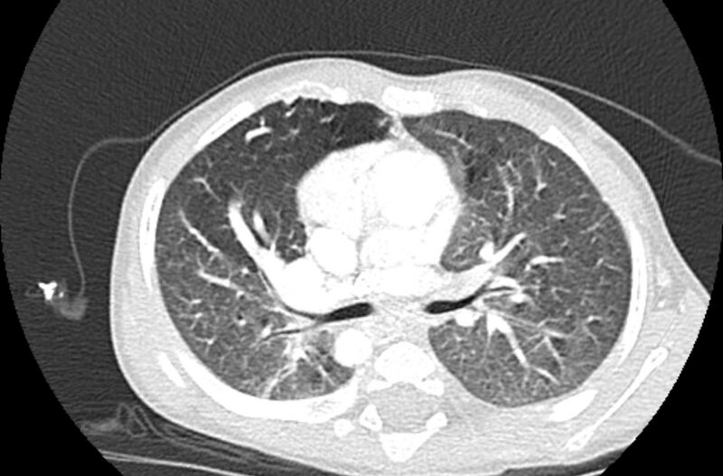 File:Asplenia syndrome (Radiopaedia 73083-83792 Axial lung window 28).jpg