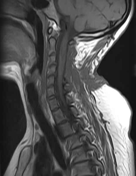 File:Astrocytoma - spinal cord (Radiopaedia 69769-79758 Sagittal T1 5).jpg