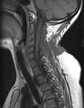 Astrocytoma - spinal cord (Radiopaedia 69769-79758 Sagittal T1 5).jpg