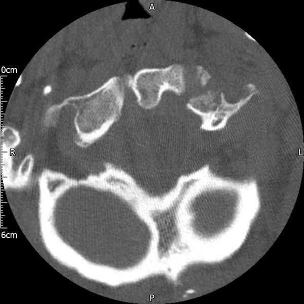 File:Atlas fracture with Currarino type A congenital defect (Radiopaedia 71747-82144 Axial bone window 37).jpg