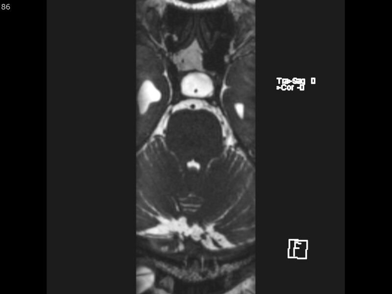 File:Atypical meningioma - intraosseous (Radiopaedia 64915-74572 Axial CISS 86).jpg
