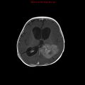 Atypical teratoid rhabdoid tumor (Radiopaedia 10712-11183 Axial T1 C+ 8).jpg