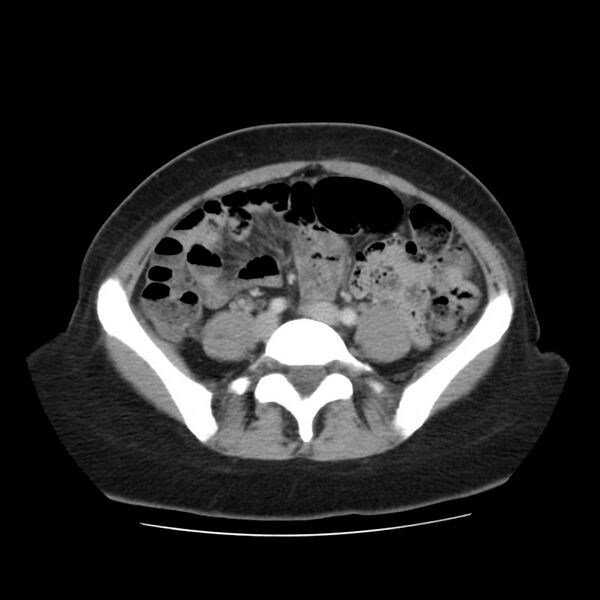 File:Autosomal dominant polycystic kidney disease (Radiopaedia 23061-23093 C 47).jpg