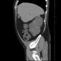 Autosomal dominant polycystic kidney disease (Radiopaedia 36539-38101 D 18).jpg