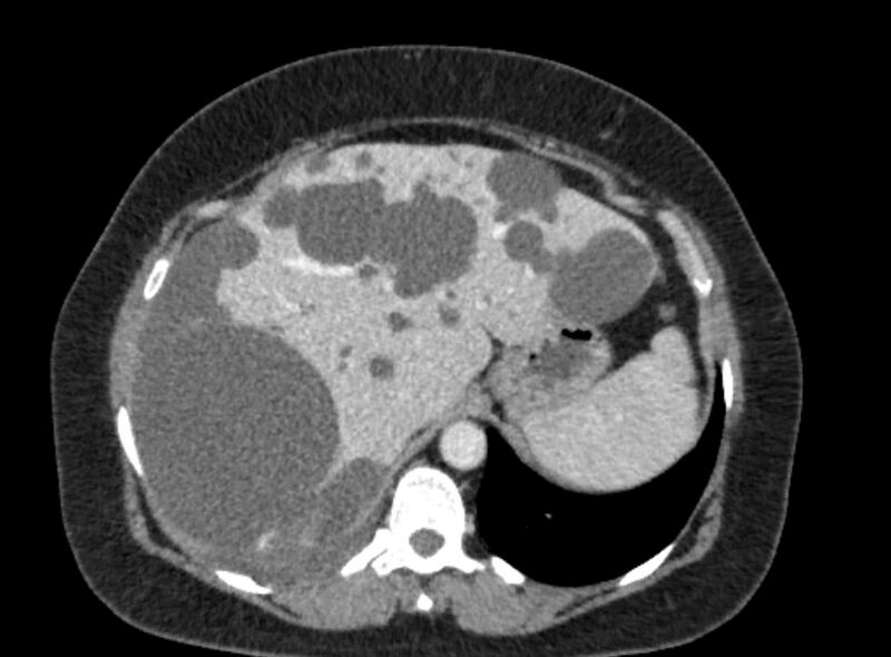 File:Autosomal dominant polycystic kidney disease (Radiopaedia 57124-64017 A 30).jpg