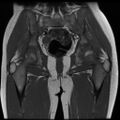 Avascular necrosis of the hip (Radiopaedia 29563-30067 Coronal T1 11).jpg