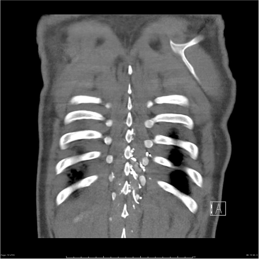 Azygos venous system anatomy (CT pulmonary angiography) (Radiopaedia 25928-26077 Coronal C+ CTPA 72).jpg