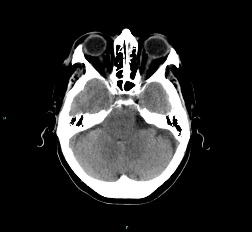 Basal ganglia hemorrhage (Radiopaedia 58775-66008 Axial non-contrast 43).jpg