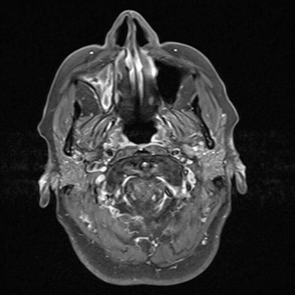 File:Base of skull chondrosarcoma (Radiopaedia 30410-31070 Axial T1 C+ fat sat 2).jpg