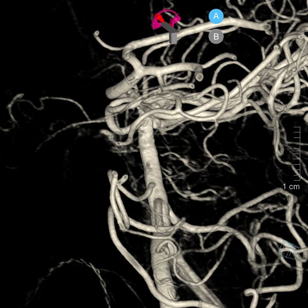 File:Basilar artery perforator aneurysm (Radiopaedia 82455-97734 3D view left VA 9).jpg