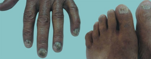 Dystrophic nails in a patient with laryngeal squamous cell carcinoma