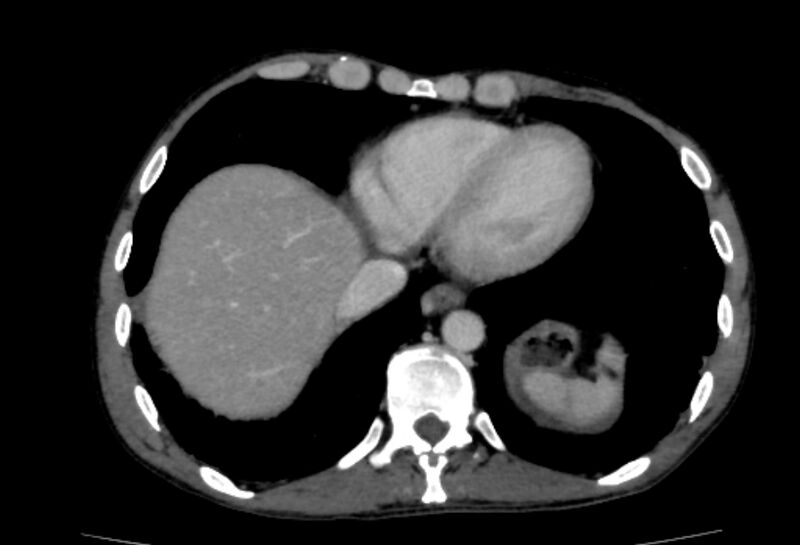 File:Behçet's disease- abdominal vasculitis (Radiopaedia 55955-62570 A 1).jpg