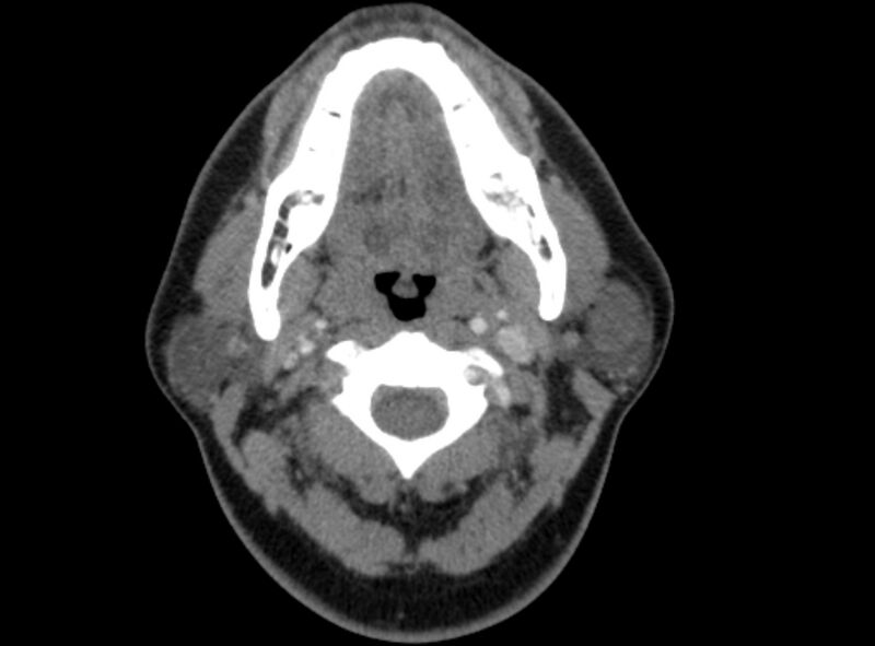 File:Benign mixed salivary tumor of the parotid gland (Radiopaedia 35261-36792 A 21).jpg