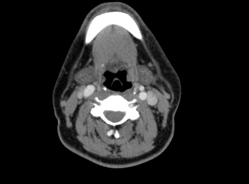 File:Benign mixed salivary tumor of the parotid gland (Radiopaedia 35261-36792 A 28).jpg