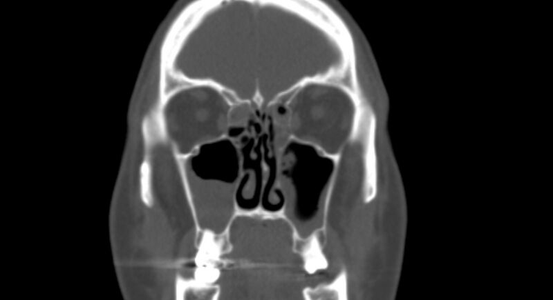 File:Benign mixed salivary tumor of the parotid gland (Radiopaedia 35261-36792 Coronal bone window 5).jpg