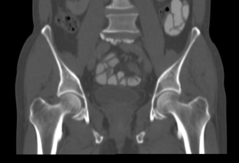 File:Bertolotti syndrome (Radiopaedia 58974-66235 Coronal bone window 22).jpg