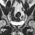 Bicornuate uterus (Radiopaedia 11104-11492 Coronal T2 7).jpg