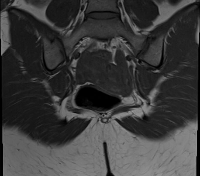 File:Bicornuate uterus (Radiopaedia 71214-81511 Coronal T1 8).jpg