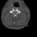 Bilateral C6-7 locked facet dislocation (Radiopaedia 28506-28748 Axial bone window 5).jpeg