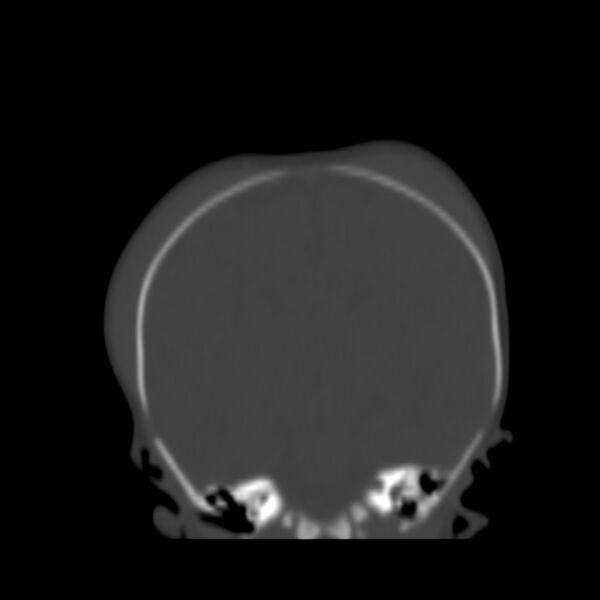 File:Bilateral cephalohematomas and subdural hematomas (Radiopaedia 26778-26929 Coronal bone window 14).jpg