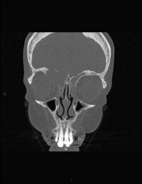 File:Bilateral frontal mucoceles (Radiopaedia 82352-96454 Coronal 103).jpg