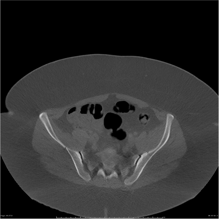 Bilateral lumbar ribs (Radiopaedia 25862-26010 bone window 48).jpg