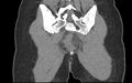 Bilateral mature cystic ovarian teratoma (Radiopaedia 88821-105592 Coronal non-contrast 39).jpg