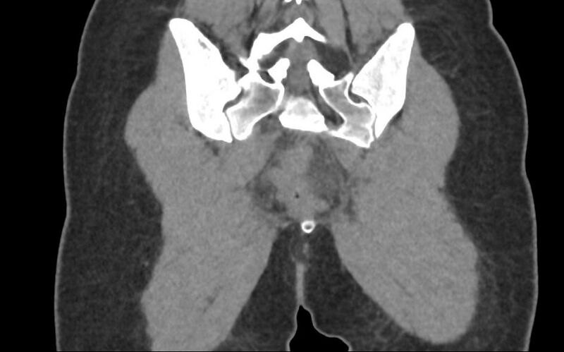 File:Bilateral mature cystic ovarian teratoma (Radiopaedia 88821-105592 Coronal non-contrast 39).jpg