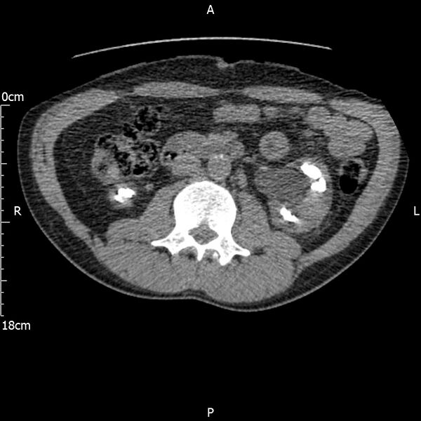 File:Bilateral medullary nephrocalcinosis with ureteric calculi (Radiopaedia 71269-81569 Axial non-contrast 53).jpg