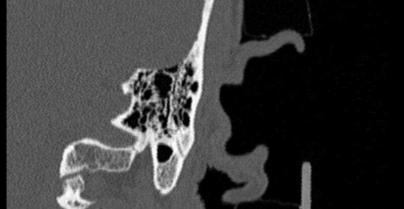 File:Bilateral temporal bone fractures (Radiopaedia 29482-29970 Coronal 252).jpg