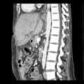 Biliary necrosis - liver transplant (Radiopaedia 21876-21846 D 5).jpg