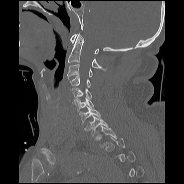 File:Blunt cerebrovascular injury (Radiopaedia 53682-59743 Sagittal bone window 8).png