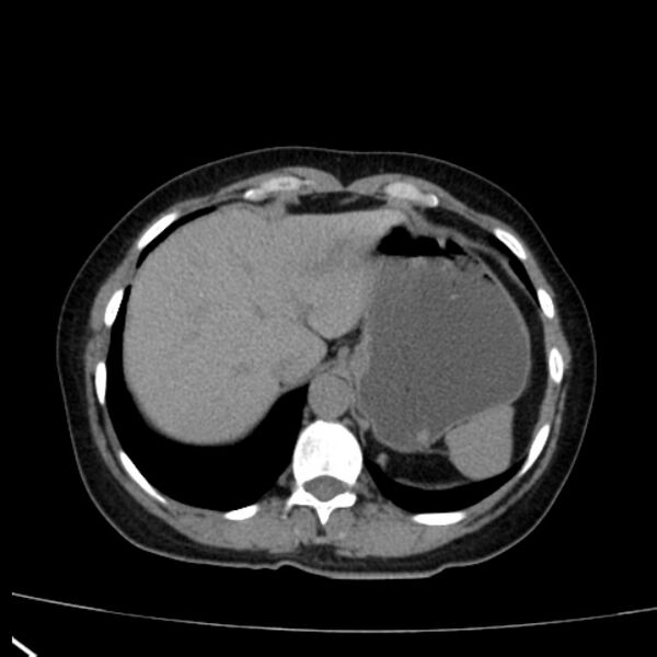 File:Bosniak renal cyst - type I (Radiopaedia 27479-27675 Axial non-contrast 14).jpg