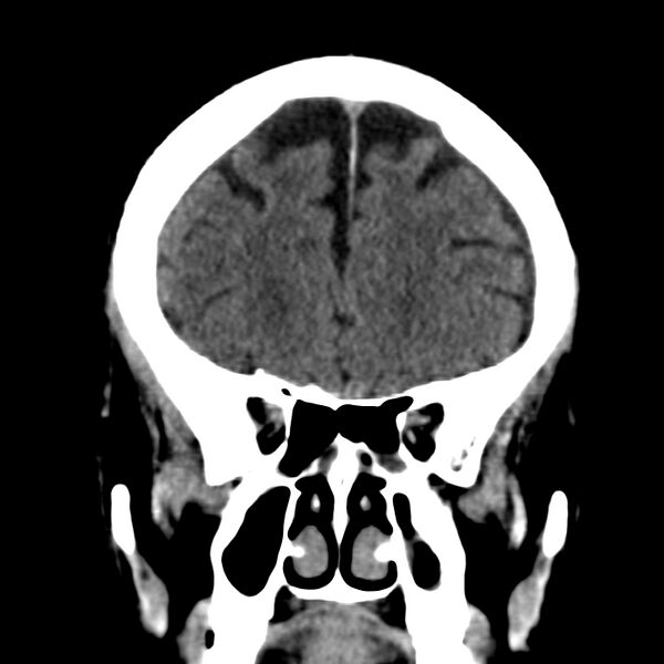 File:Brain Pantopaque remnants (Radiopaedia 78403-91048 Coronal non-contrast 21).jpg