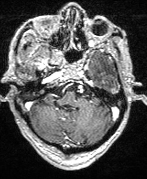 File:Brain abscess with dual rim sign (Radiopaedia 87566-103938 Axial T1 C+ 42).jpg
