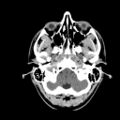 Brain death (Radiopaedia 78597-91360 Axial non-contrast 12).jpg