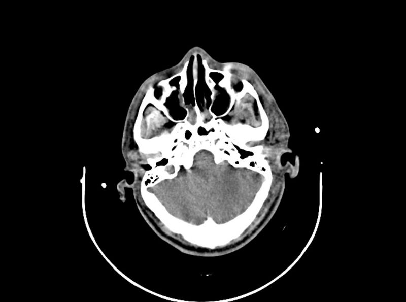 File:Brain injury by firearm projectile (Radiopaedia 82068-96087 B 60).jpg