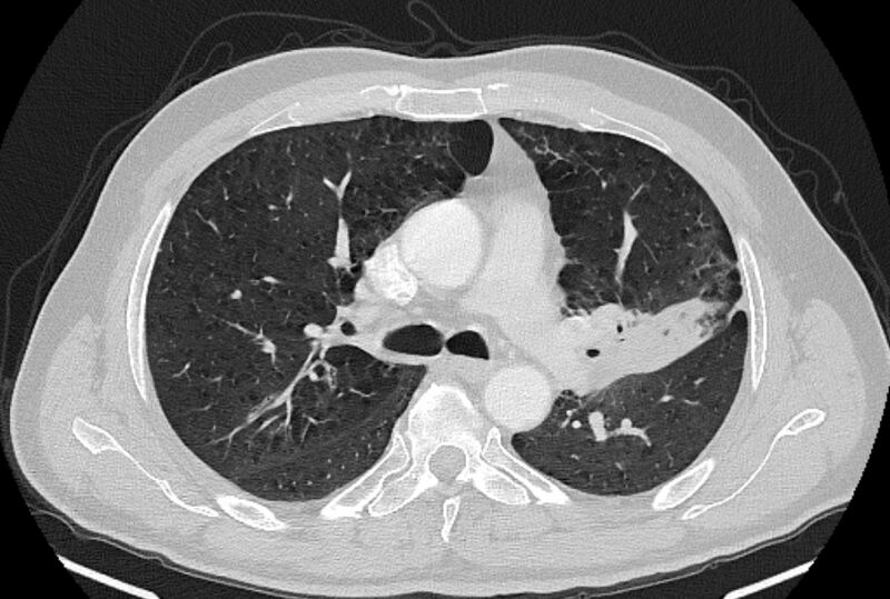 File:Brain metastases - lung cancer primary (Radiopaedia 75060-86116 Axial lung window 22).jpg
