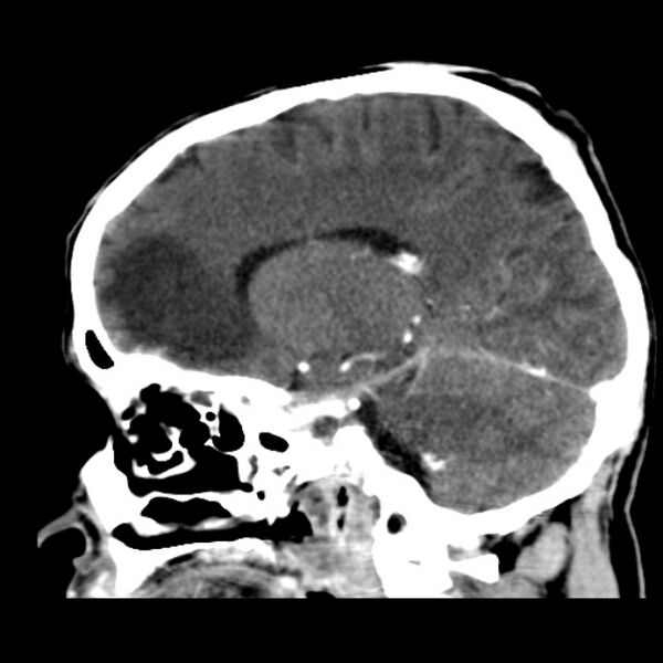 File:Brain metastases from lung cancer (Radiopaedia 24480-24781 C+ delayed 35).jpg