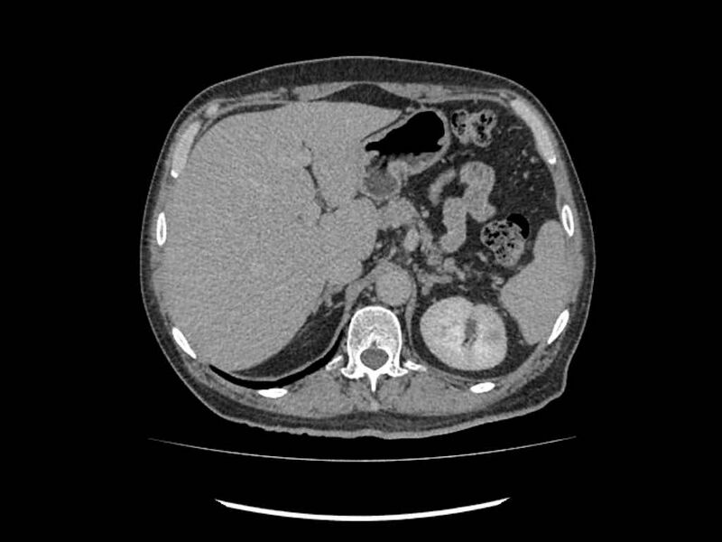 File:Brain metastases from renal cell carcinoma (Radiopaedia 42222-45328 Axial C+ delayed 22).jpg
