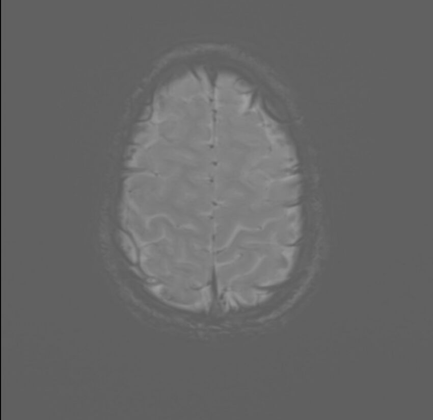 Brainstem glioma (Radiopaedia 70548-80674 Axial SWI 56).jpg