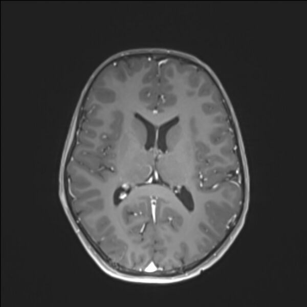 File:Brainstem glioma (Radiopaedia 70548-80674 Axial T1 C+ 92).jpg