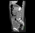 Broad ligament hernia (Radiopaedia 63260-71832 C 33).jpg
