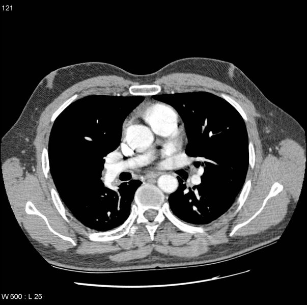 File:Bronchial arterial aneurysm (Radiopaedia 22293-22330 A 9).jpg