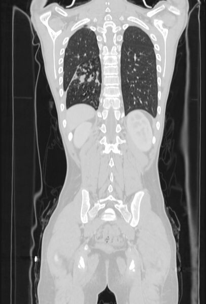 File:Bronchial carcinoid tumor (Radiopaedia 57187-64090 Coronal lung window 90).jpg