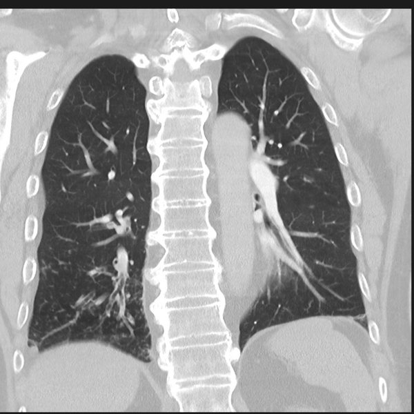 File:Bronchiectasis (Radiopaedia 39385-41666 Coronal lung window 23).png