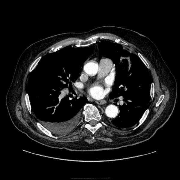 File:Bronchogenic adenocarcinoma and pulmonary embolism (Radiopaedia 9097-9806 D 33).jpg