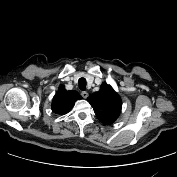 File:Bronchogenic carcinoma with L1 vertebra metastasis (Radiopaedia 9096-9805 Axial C+ delayed 1).jpg